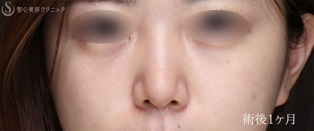 【20代女性・鼻先をスッキリ整える】鼻尖縮小＋鼻尖形成（耳介軟骨移植術）（1ヶ月後） After 