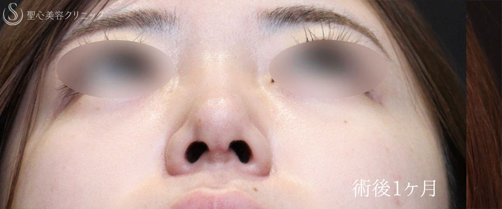【20代女性・鼻先をスッキリ整える】鼻尖縮小＋鼻尖形成（耳介軟骨移植術）（1ヶ月後） After 