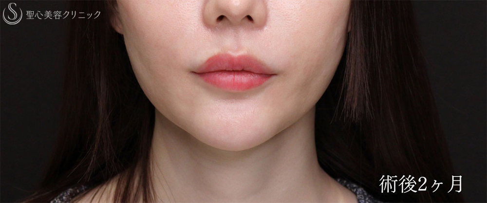 【30代女性・プロテーゼの位置調整で理想のEラインに】あごプロテーゼ（2ヶ月後） After 