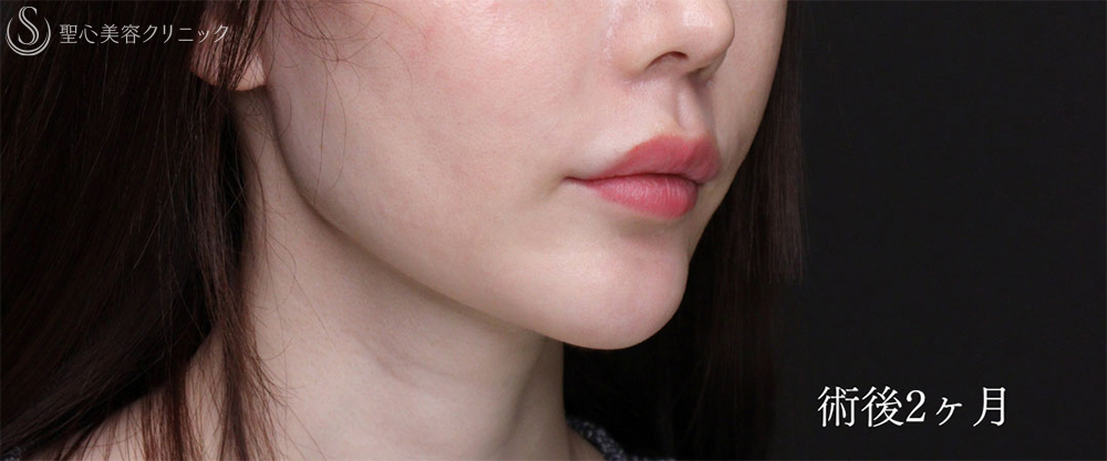 【30代女性・プロテーゼの位置調整で理想のEラインに】あごプロテーゼ（2ヶ月後） After 