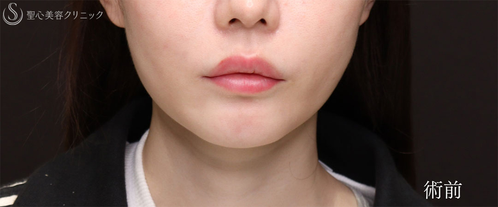 【30代女性・プロテーゼの位置調整で理想のEラインに】あごプロテーゼ（2ヶ月後） Before 
