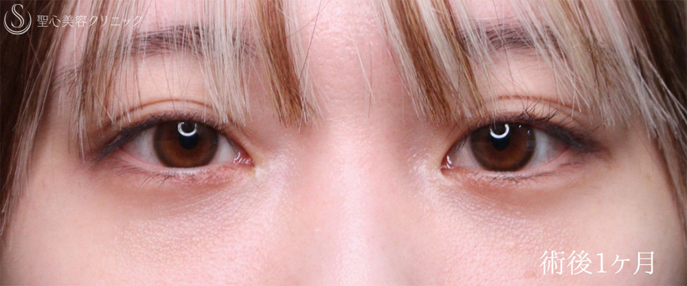 【20代女性・裏ハムラで目の下のクマをスッキリ改善】下眼瞼切開術/下眼瞼除皺術/ハムラ法（1ヶ月後） After 