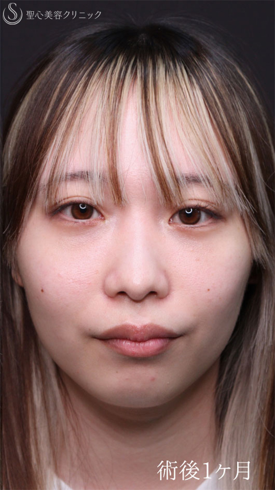 【20代女性・裏ハムラで目の下のクマをスッキリ改善】下眼瞼切開術/下眼瞼除皺術/ハムラ法（1ヶ月後） After 