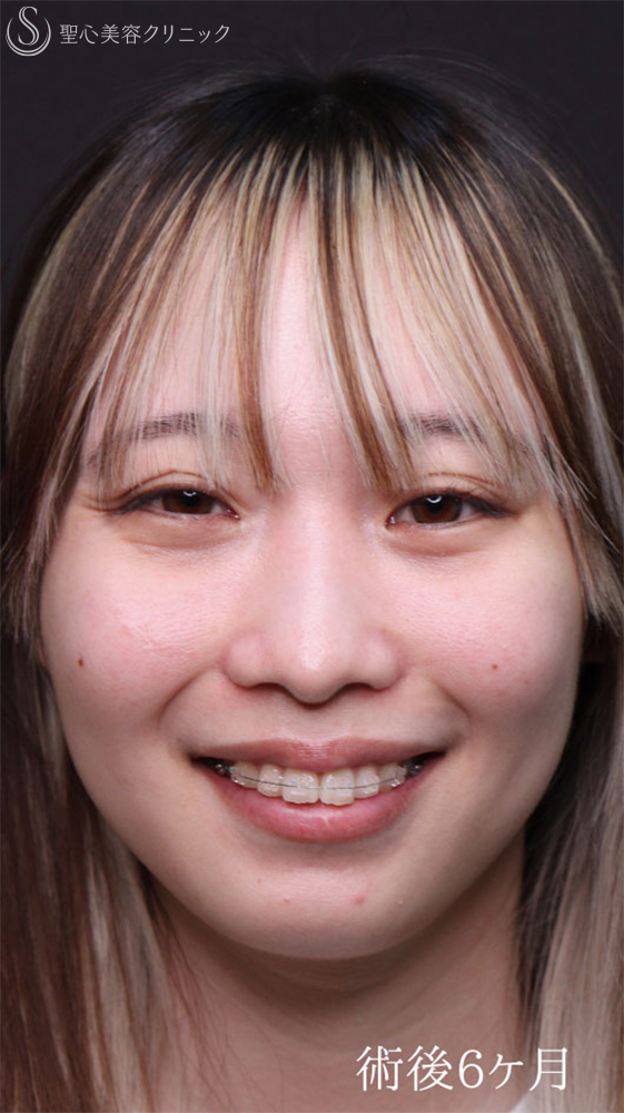 【20代女性・裏ハムラで目の下のクマをスッキリ改善】下眼瞼切開術/下眼瞼除皺術/ハムラ法（1ヶ月後） After 