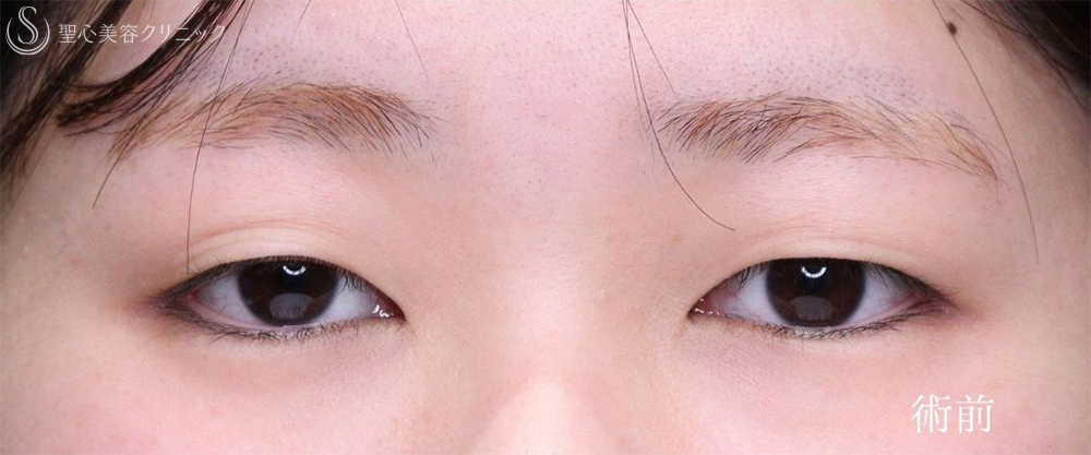 【20代女性・目の開きを改善して自然な目力アップ】眼瞼下垂施術（1ヶ月後） Before 