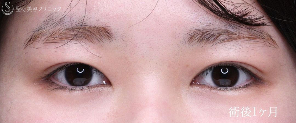 【20代女性・目の開きを改善して自然な目力アップ】眼瞼下垂施術（1ヶ月後） After 