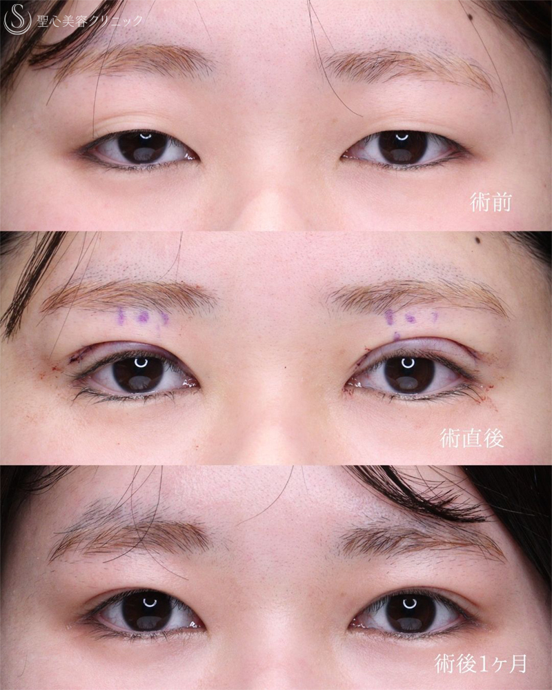 【20代女性・目の開きを改善して自然な目力アップ】眼瞼下垂施術（1ヶ月後） After 