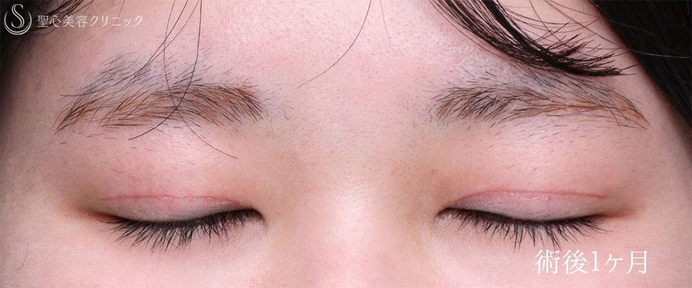 【20代女性・目の開きを改善して自然な目力アップ】眼瞼下垂施術（1ヶ月後） After 