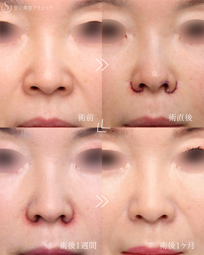 【60代女性・アンチエイジング】小鼻縮小（1ヶ月後） After 