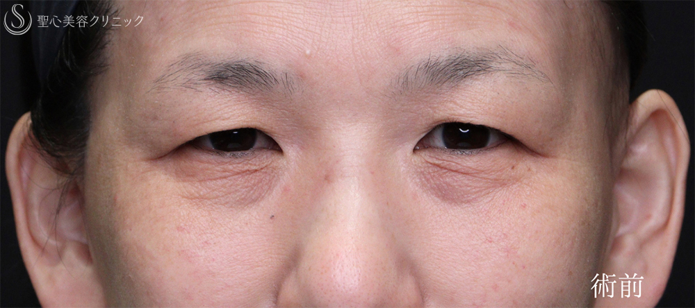 【50代女性・目の上下のたるみを劇的改善】眉下リフト＋ハムラ法（1.5ヶ月後） Before 