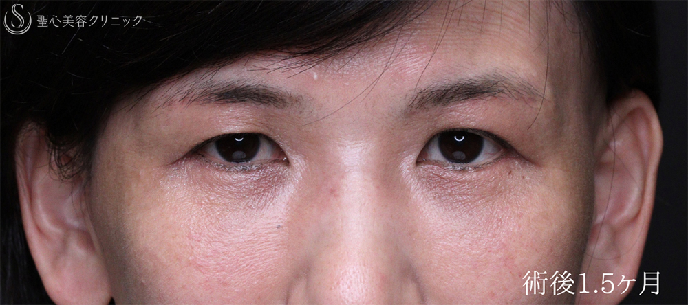 【50代女性・目の上下のたるみを劇的改善】眉下リフト＋ハムラ法（1.5ヶ月後） After 