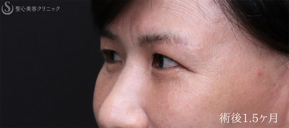 【50代女性・目の上下のたるみを劇的改善】眉下リフト＋ハムラ法（1.5ヶ月後） After 