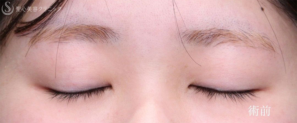 【20代女性・目の開きを改善して自然な目力アップ】眼瞼下垂施術（1ヶ月後） Before 