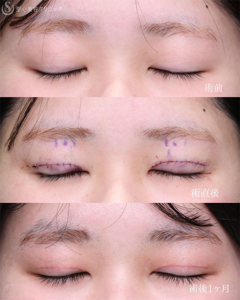【20代女性・目の開きを改善して自然な目力アップ】眼瞼下垂施術（1ヶ月後） After 