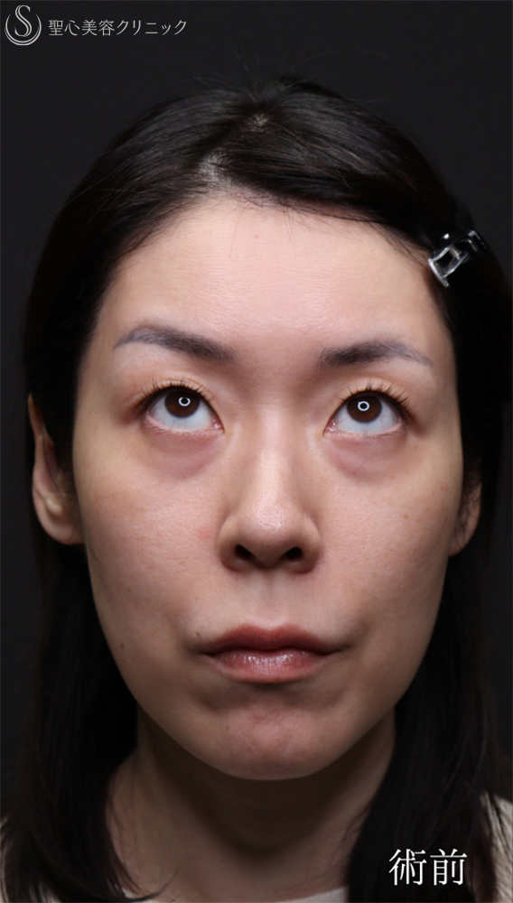【40代女性・目の下のクマをスッキリ】裏ハムラ法（直後～1ヶ月後） Before 