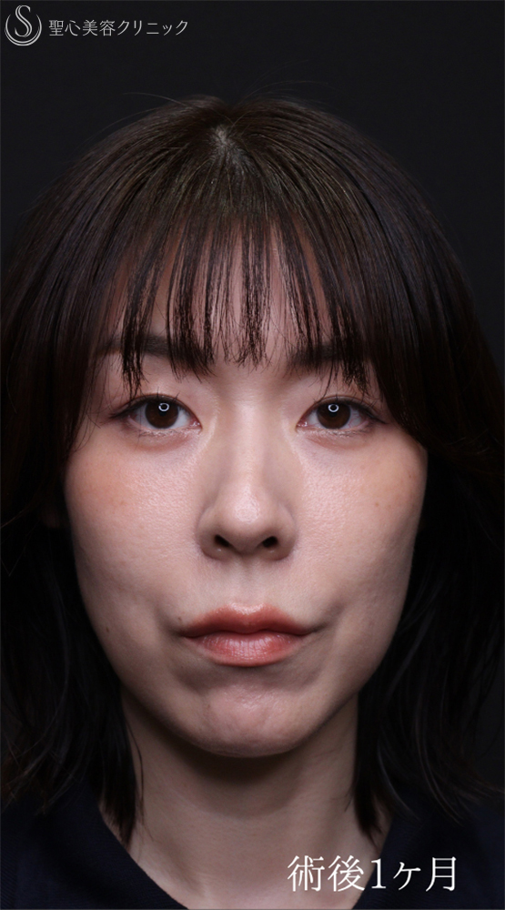 【40代女性・目の下のクマをスッキリ】裏ハムラ法（直後～1ヶ月後） After 