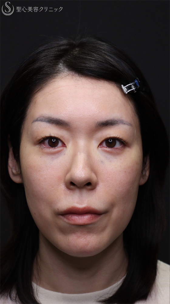 【40代女性・目の下のクマをスッキリ】裏ハムラ法（直後～1ヶ月後） After 