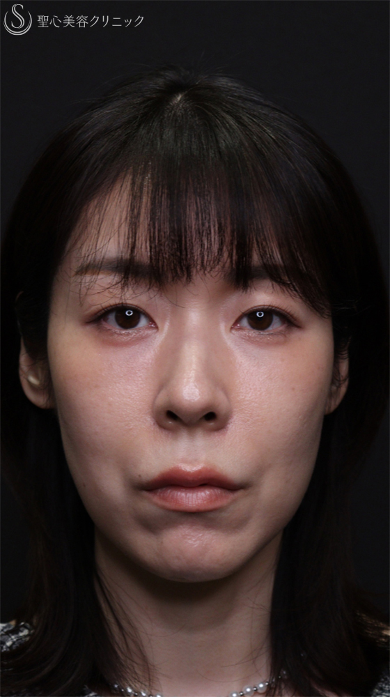 【40代女性・目の下のクマをスッキリ】裏ハムラ法（直後～1ヶ月後） After 