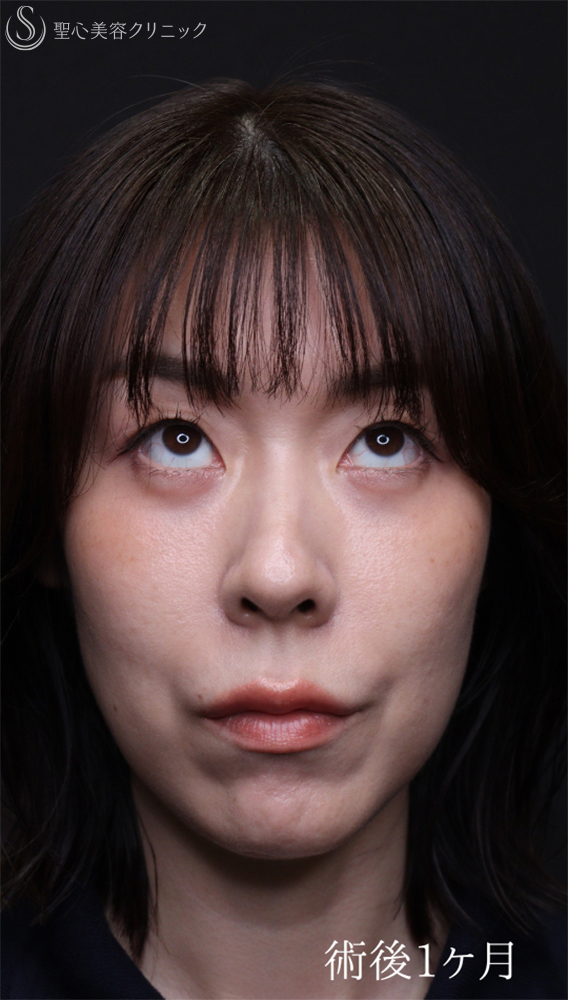 【40代女性・目の下のクマをスッキリ】裏ハムラ法（直後～1ヶ月後） After 