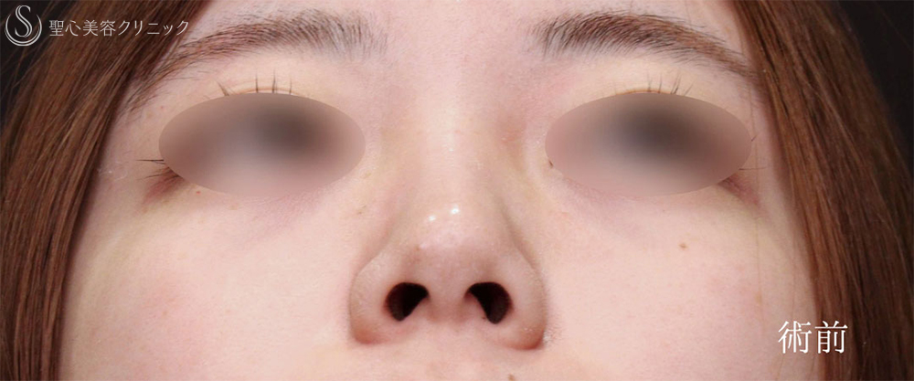 【20代女性・鼻先をスッキリ整える】鼻尖縮小＋鼻尖形成（耳介軟骨移植術）（1ヶ月後） Before 