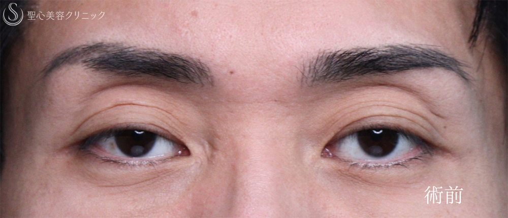 【30代男性・目の開きを改善して凛々しい目元に】眼瞼下垂手術（1ヶ月後） Before 