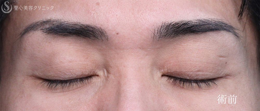 【30代男性・目の開きを改善して凛々しい目元に】眼瞼下垂手術（1ヶ月後） Before 
