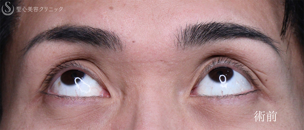 【30代男性・目の開きを改善して凛々しい目元に】眼瞼下垂手術（1ヶ月後） Before 