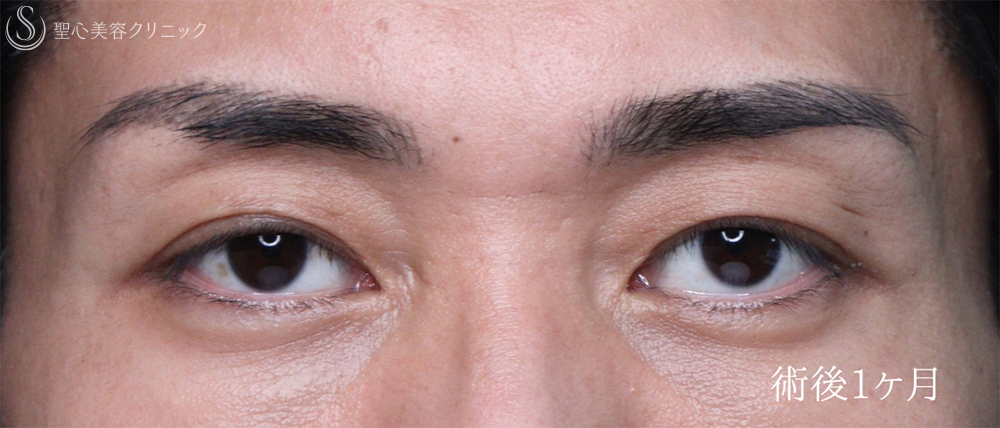 【30代男性・目の開きを改善して凛々しい目元に】眼瞼下垂手術（1ヶ月後） After 