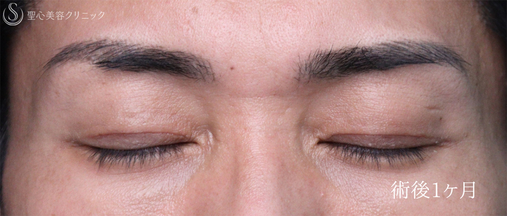 【30代男性・目の開きを改善して凛々しい目元に】眼瞼下垂手術（1ヶ月後） After 