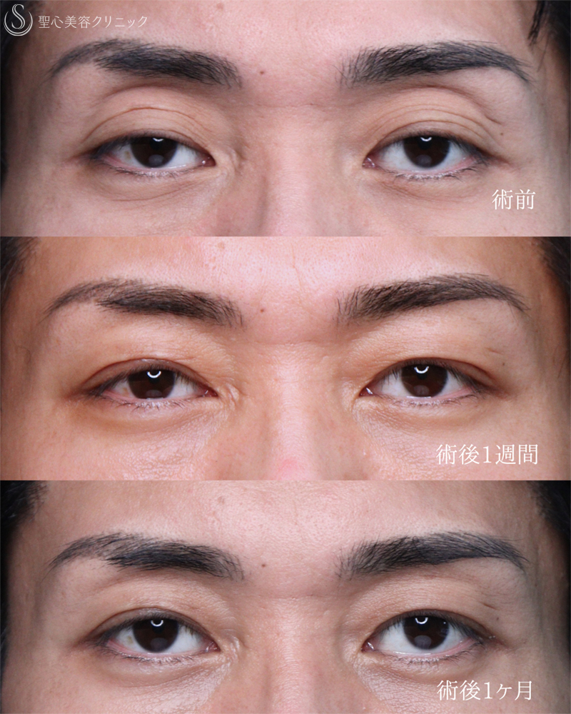 【30代男性・目の開きを改善して凛々しい目元に】眼瞼下垂手術（1ヶ月後） After 