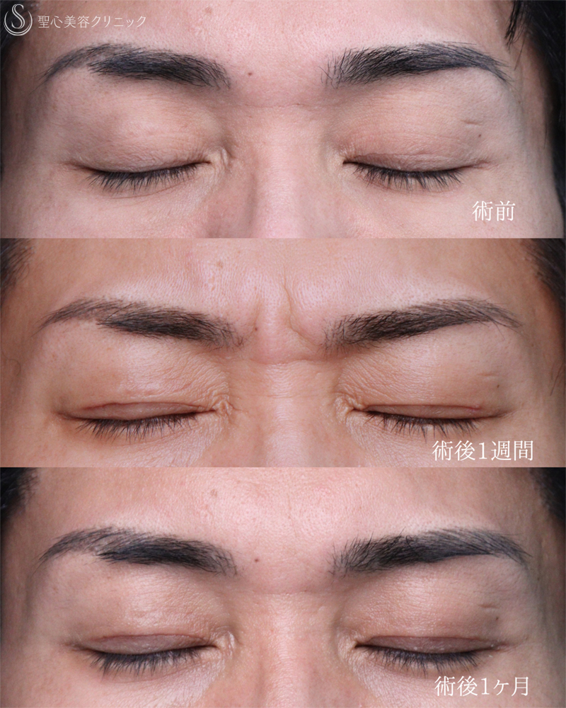 【30代男性・目の開きを改善して凛々しい目元に】眼瞼下垂手術（1ヶ月後） After 