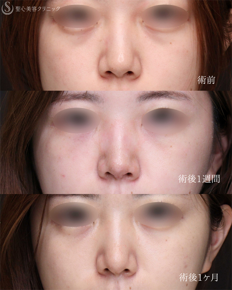 【20代女性・鼻先をスッキリ整える】鼻尖縮小＋鼻尖形成（耳介軟骨移植術）（1ヶ月後） After 