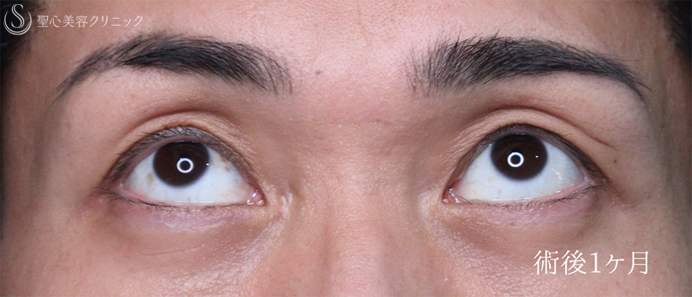 【30代男性・目の開きを改善して凛々しい目元に】眼瞼下垂手術（1ヶ月後） After 