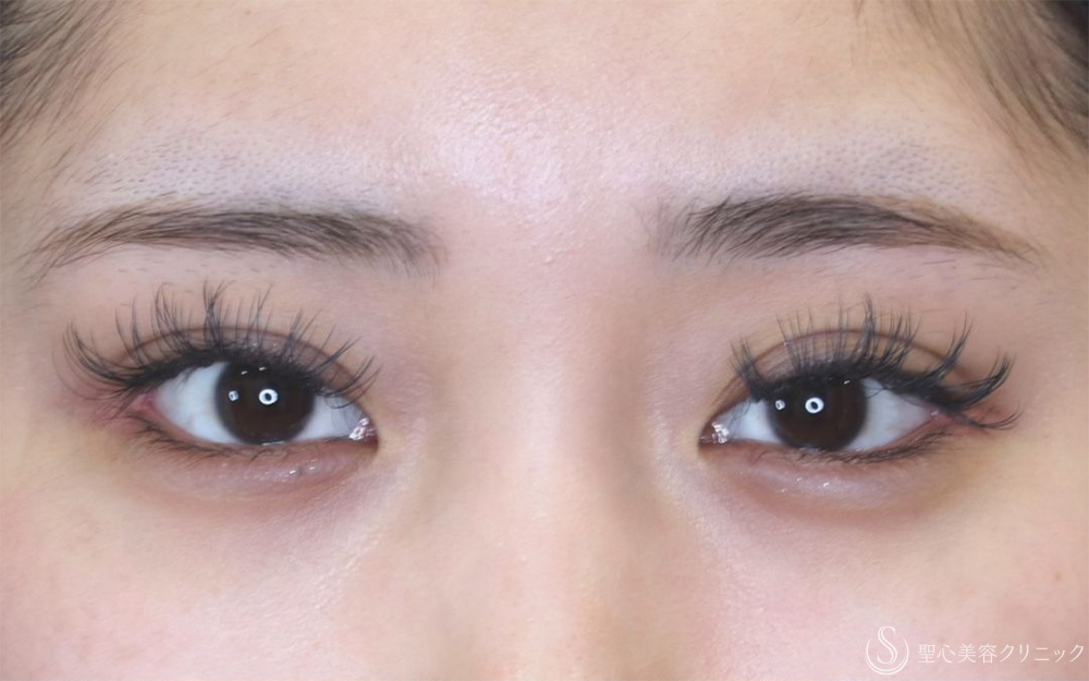 【20代女性・他院眼瞼下垂後左ハム目修正】睫毛上皮膚切開（1ヶ月後） Before 