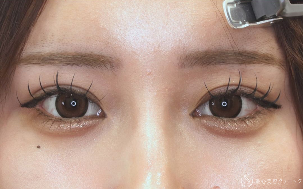 【20代女性・他院眼瞼下垂後左ハム目修正】睫毛上皮膚切開（1ヶ月後） After 