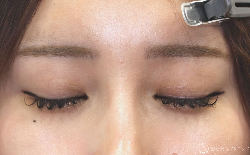 【20代女性・他院眼瞼下垂後左ハム目修正】睫毛上皮膚切開（1ヶ月後） After 