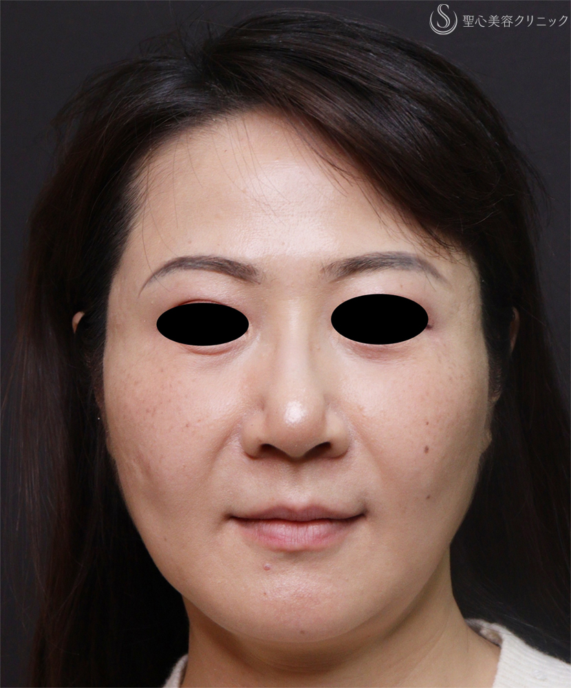 【50代女性・ほうれい線など】トータルフェイシャルトリートメント（3ヶ月後） Before 