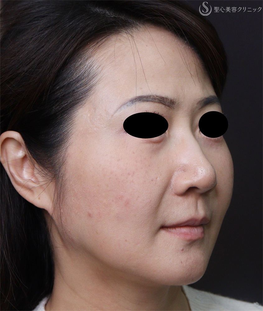 【50代女性・ほうれい線など】トータルフェイシャルトリートメント（3ヶ月後） Before 