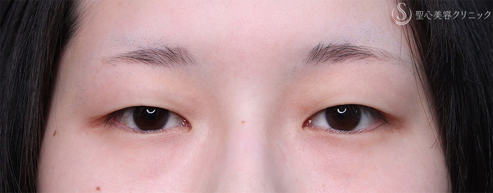 【20代女性・二重まぶた】マイクロメソッド+α（3点）（2ヶ月後） Before 