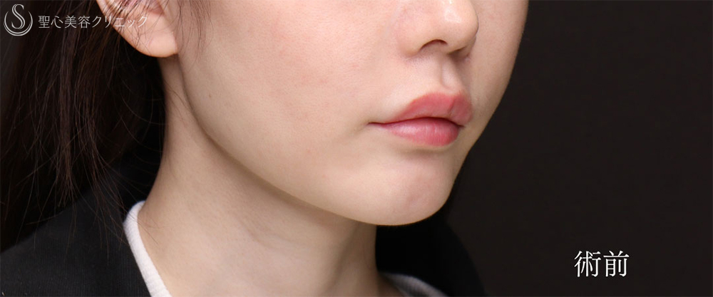 【30代女性・プロテーゼの位置調整で理想のEラインに】あごプロテーゼ（2ヶ月後） Before 