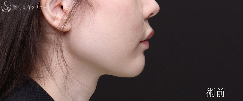 【30代女性・プロテーゼの位置調整で理想のEラインに】あごプロテーゼ（2ヶ月後） Before 