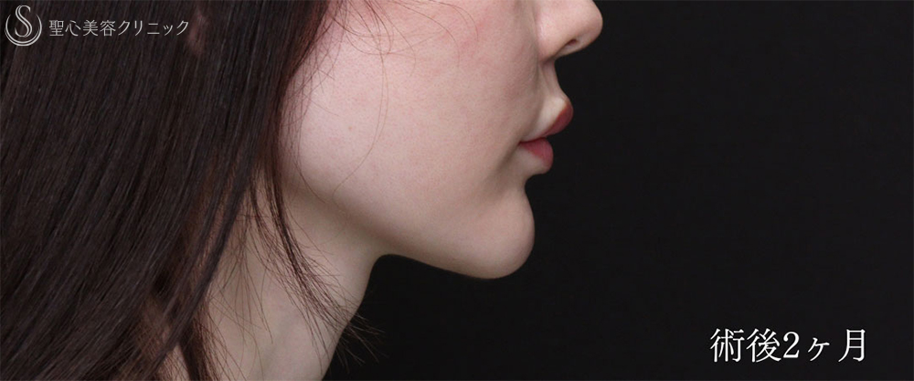 【30代女性・プロテーゼの位置調整で理想のEラインに】あごプロテーゼ（2ヶ月後） After 