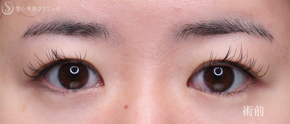 【30代女性・自然なパッチリ二重に】二重切開法（1ヶ月後） Before 
