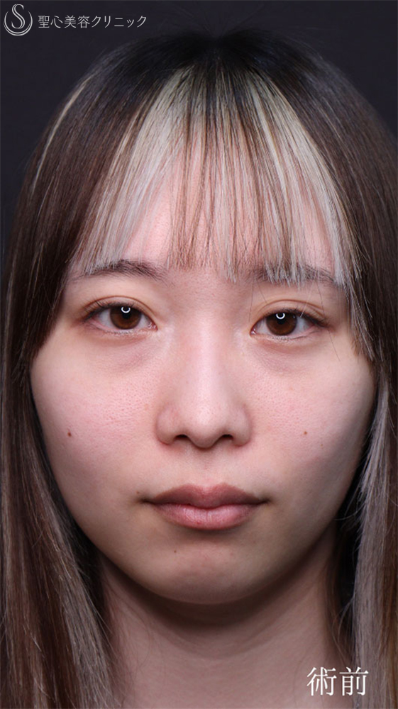 【20代女性・裏ハムラで目の下のクマをスッキリ改善】下眼瞼切開術/下眼瞼除皺術/ハムラ法（1ヶ月後） Before 