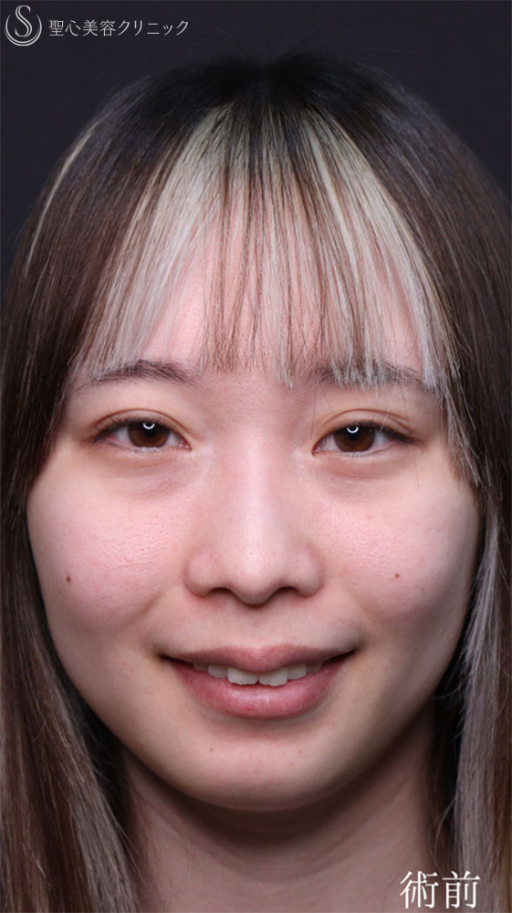 【20代女性・裏ハムラで目の下のクマをスッキリ改善】下眼瞼切開術/下眼瞼除皺術/ハムラ法（1ヶ月後） Before 