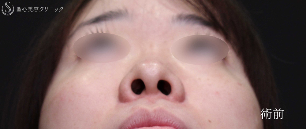 【20代女性・理想的な忘れ鼻に】鼻尖縮小＋小鼻縮小（1ヶ月後） Before 