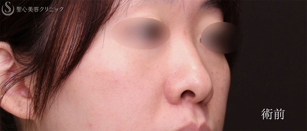 【20代女性・理想的な忘れ鼻に】鼻尖縮小＋小鼻縮小（1ヶ月後） Before 