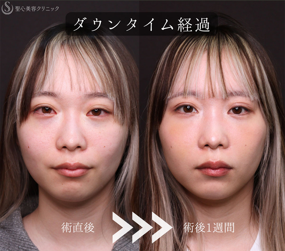 【20代女性・裏ハムラで目の下のクマをスッキリ改善】下眼瞼切開術/下眼瞼除皺術/ハムラ法（1ヶ月後） After 