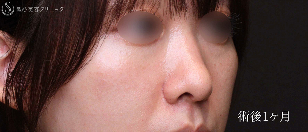 【20代女性・理想的な忘れ鼻に】鼻尖縮小＋小鼻縮小（1ヶ月後） After 