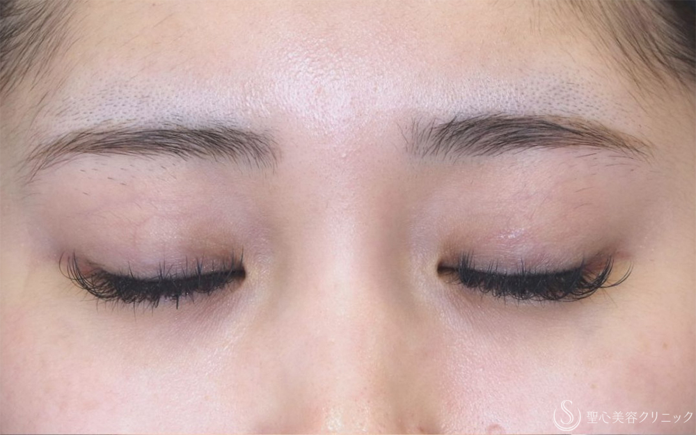 【20代女性・他院眼瞼下垂後左ハム目修正】睫毛上皮膚切開（1ヶ月後） Before 
